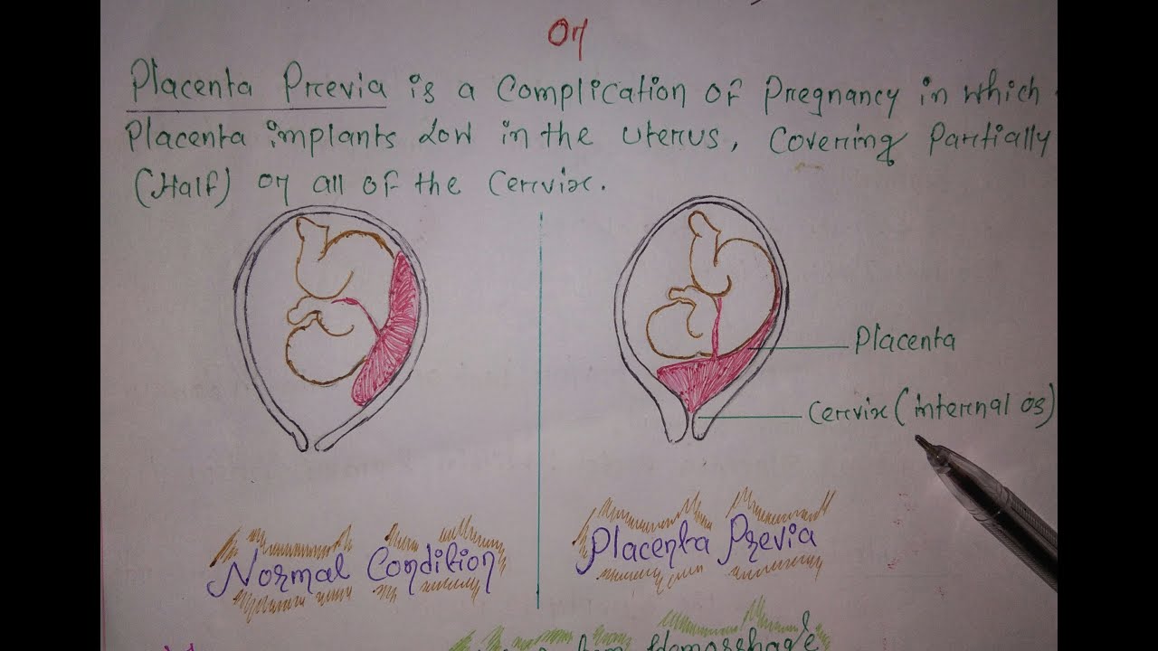 PLACENTA PREVIA - YouTube