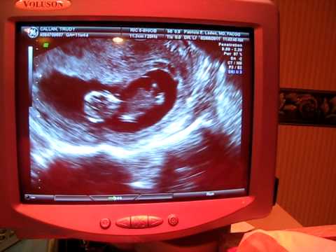 First Ultrasound of our Baby at 11 1/2 Weeks