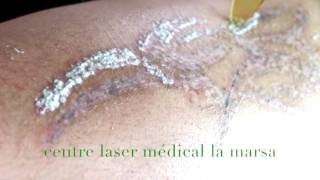 Detatouage par laser Q Switché