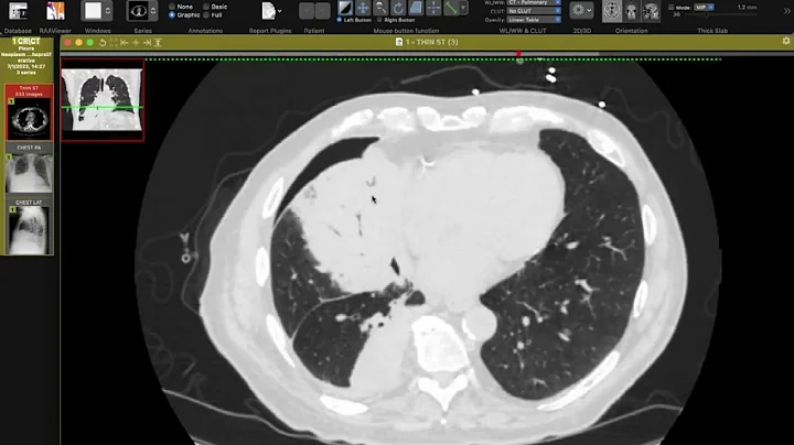 STR Cardiothoracic Case Webinar 12/1/2022