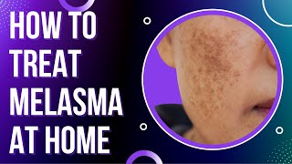 How to treat  MELASMA at Home -  Treat DARK SPOTS & PATCHES on the skin