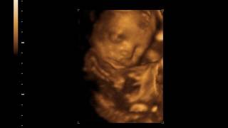 2d 3d Twin Ultrasound At 24 Weeks Youtube