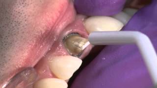 Crown Cementation Using PermaFlo DC screenshot 5