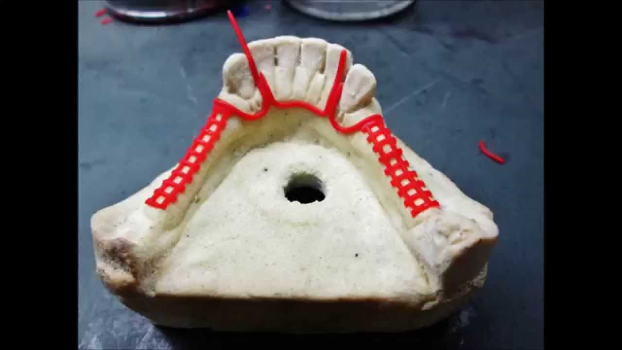 Passo a Passo de uma estrutura metálica para Prótese Parcial Removível