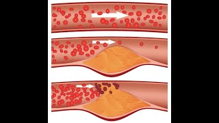 Blood Clots - what causes them? How do you reduce your risk?