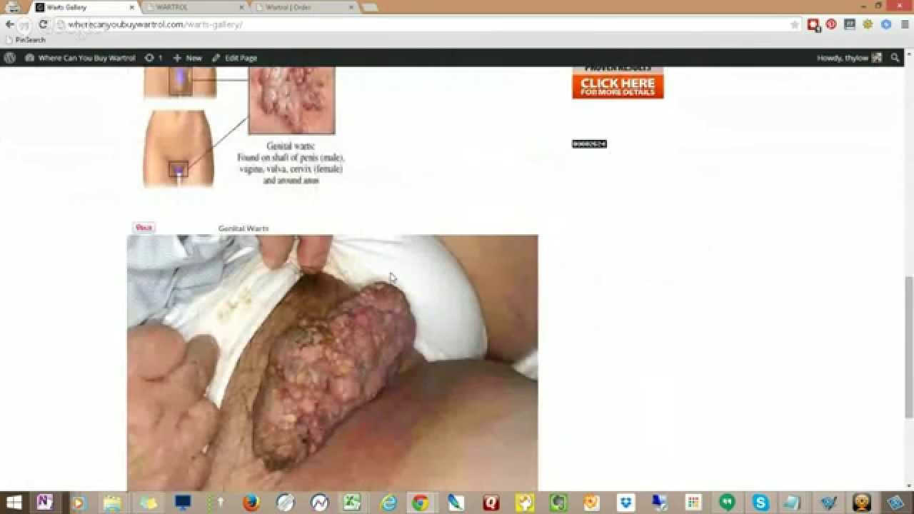 Wartol Review for Genetal Warts