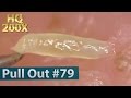 #79 Pull Out Blackheads Close up 200X - Blackheads Removal | ピンセットで角栓を抜く(HQ200倍)