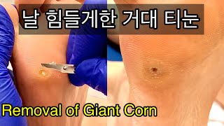 (ENG) 걷기힘든 발바닥 티눈 치료!!티눈핵을 뺐더니 싱크홀 생김 Removal painful giant corn and callous