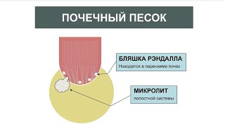 Почечный песок, чем опасен и может ли привести к камнеобразованию