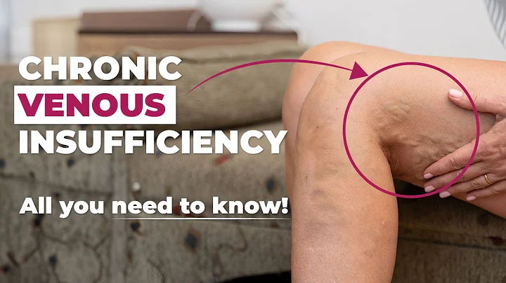 Complete Guide of Chronic Venous Insufficiency: Symptoms, Causes & Treatments