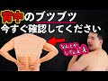 それはニキビではなくカビです【改善方法アリ】