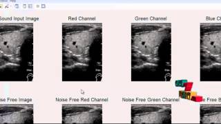 Final Year Projects | Thyroid Segmentation and Volume Estimation in Ultrasound Images