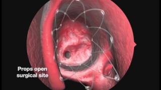 PROPEL Educational Video