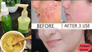 I applied this for 3 Days on Acne Marks Dark Spots & Pimples and see what Happened screenshot 5