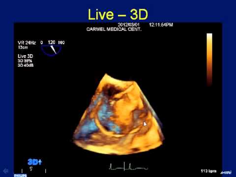 3D Echo Guided Post-MI VSD