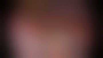 Subxiphoid VATS Right S2 Segmentectomy