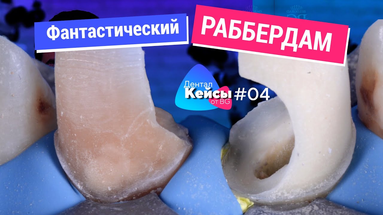 Раббердам, препарирование и эндодонтия на грани фантастики. Дентал Кейсы от BG. #04