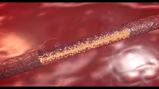 How Does IV Therapy Work