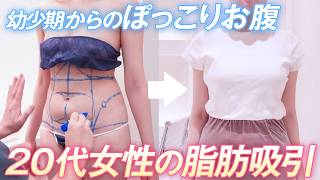 【脂肪吸引】長年悩んでいたぽっこりお腹が6ヶ月で無くなった！…のサムネイル