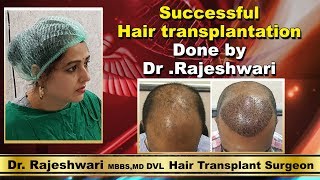 Successfull Hair Transplantation Done By Dr Rajeshwari | Patient | Dr  Rajeshwari Health Care - YouTube