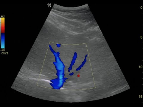 Hepatic Vein Doppler - Normal Flow