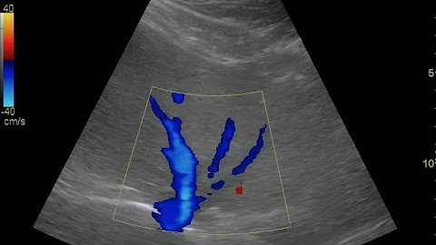 Hepatic Vein Doppler - Normal Flow