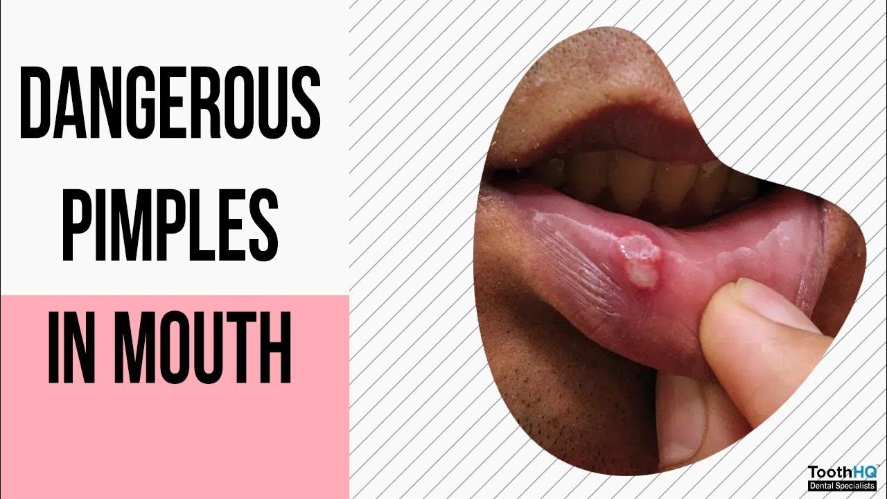 Red Pimple In Mouth