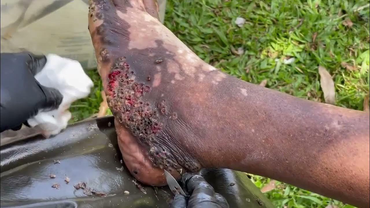 Jigger Digging Obed's Left Foot Part A heavy clusters of big and small