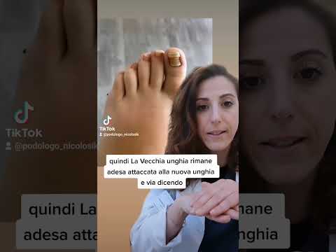 Video: Quando andrà via l'onicolisi?