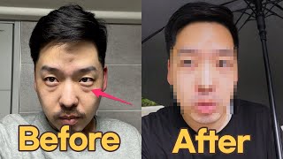 I GOT PLASTIC SURGERY! (ft. Under Eye Fat Removal)