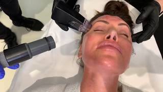 Morpheus8 | Skin Tightening | Microneedling & Radiofrequency | West Hollywood, CA | Dr. Jason Emer