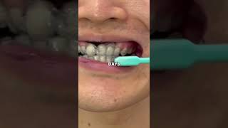 歯の黄ばみ無くしてみた680円で買えたページはプロフに載せた