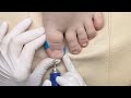 The titanium thread in pedicure #asmrvideo #pedicure #drypedicure