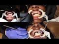 WATCH ME GET BRACES