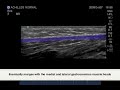 How To: Ankle - Achilles Post-Op Case Study Video