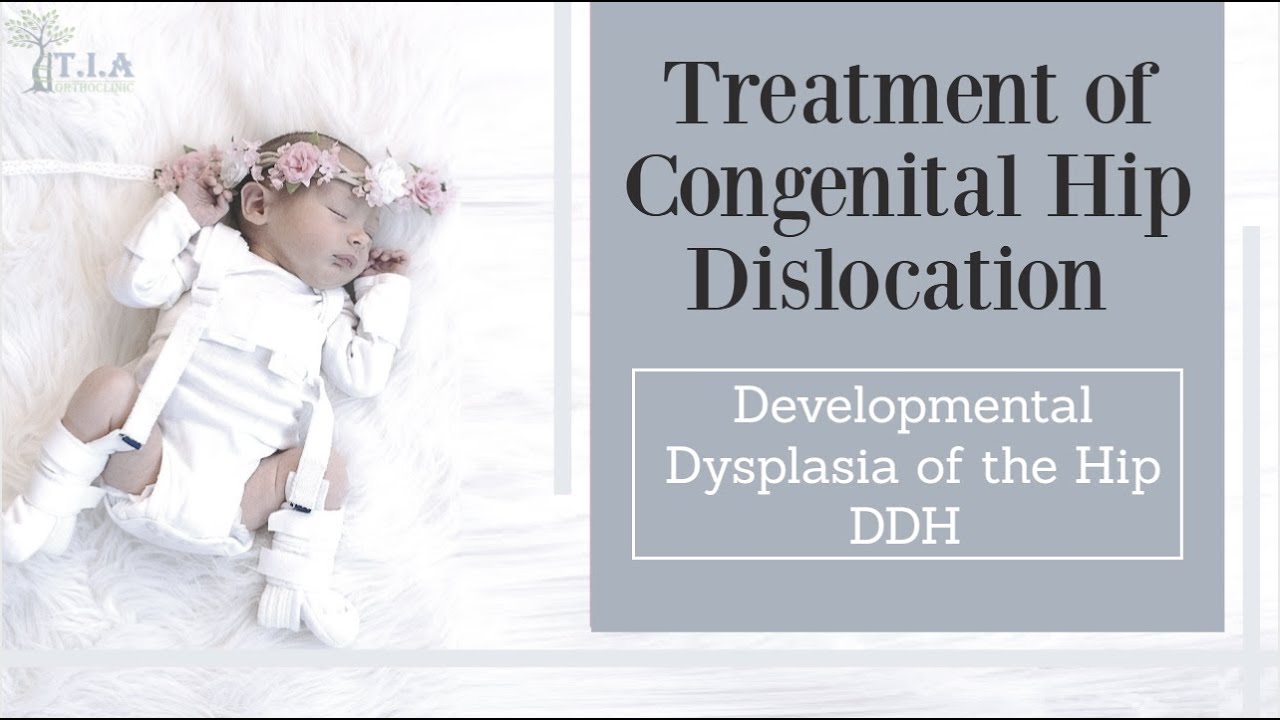 Congenital Hip Dislocation Treatment Developmental Dysplasia Of The Congenital Hip Dislocation Treatment Developmental Dysplasia Of The