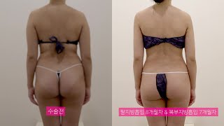 바비라인의원 팔지방흡입 8개월 차 + 복부지방흡입 7개월 차  전후영상