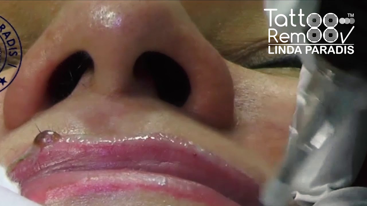 Permanent Makeup Removal - TattooRemoov