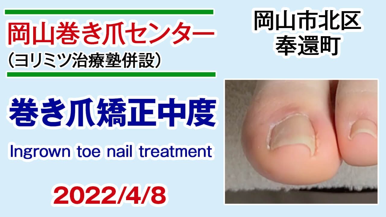 岡山市北区奉還町 岡山巻き爪センター ヨリミツ治療塾内 巻き爪矯正中度 Treating Ingrown Toe Nail Youtube