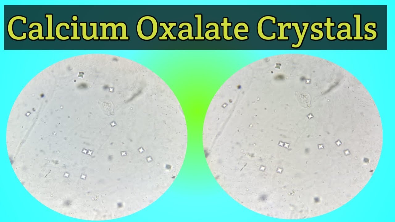 Calcium Oxalate Crystals in Urine | Crystals | Urine Crystals | Urine ...