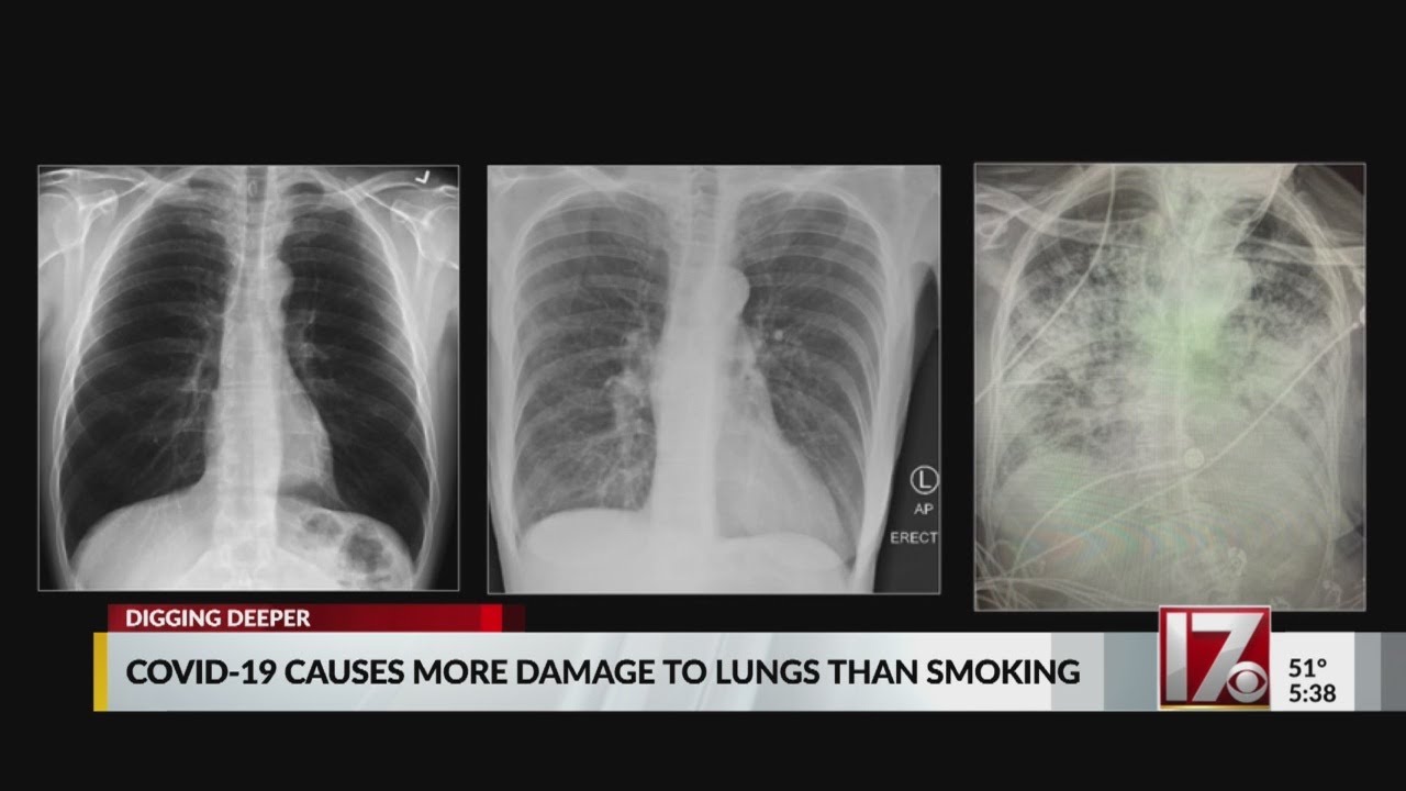 COVID19 infected lungs damaged more than smoker’s lung, doctor says