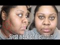 MY FIRST SEVEN DAYS USING TRETINOIN // Sherelle Saint Rose