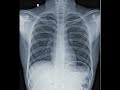 Normal X Ray Abnormal Consolidation X Ray Aiims Biology Normal X Ray Abnormal Consolidation X Ray Aiims Biology