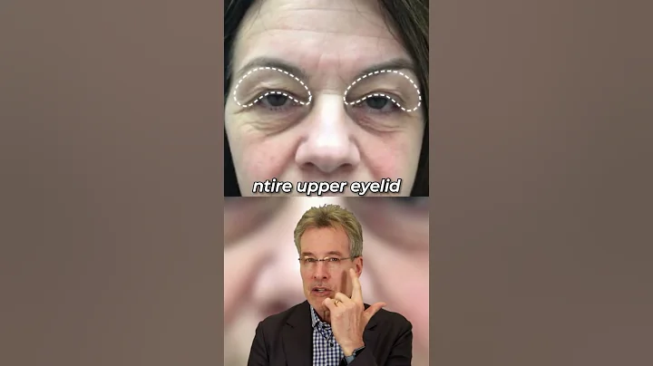 Brow Lift VS Blepharoplasty | #browlift #eyelift #eyes