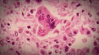 Second child dies in Texas measles outbreak