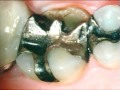 Cracked Filling, tooth needs a crown Delray Beach Dentist