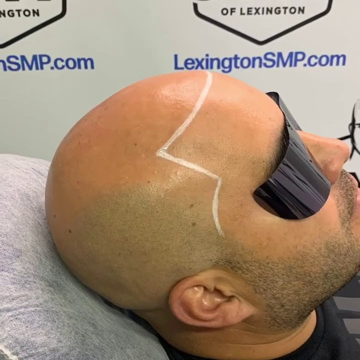 Hair Loss Treatment - Lexington, Kentucky
