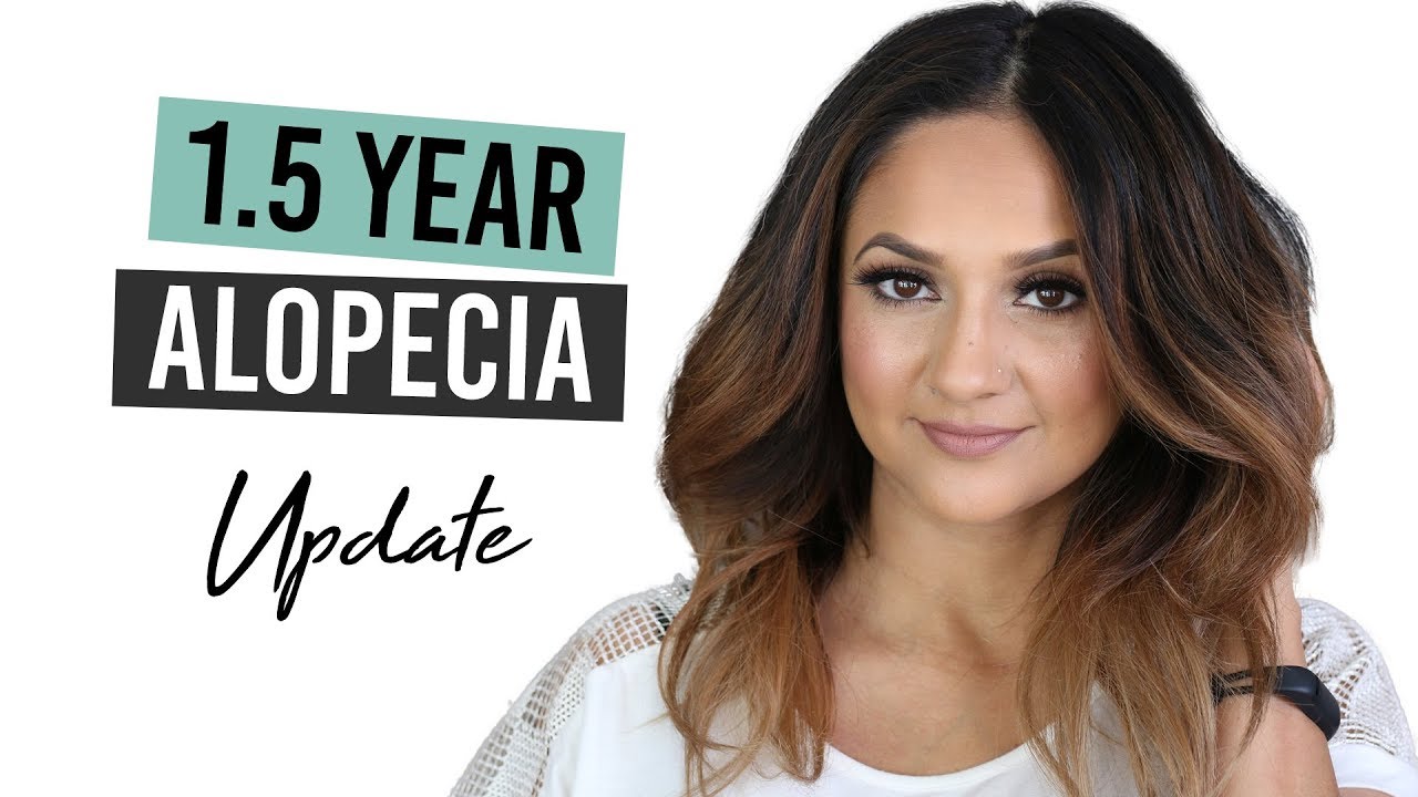 1.5 Year Alopecia Areata Update