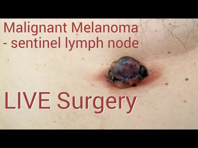 Medic: „Depistat la timp, melanomul se poate vindeca“ | dentisttimisoaraa.ro