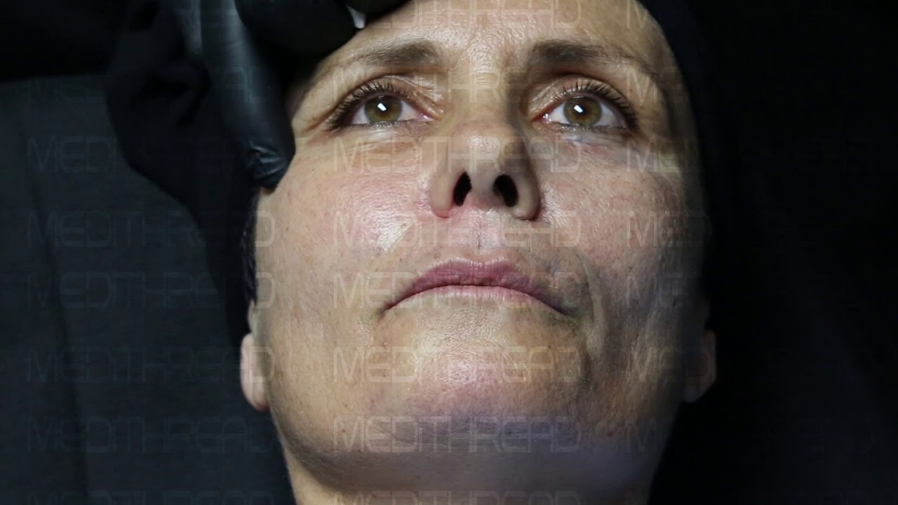 PDO-THREAD LIFT TUTORIAL BY MEDiTHREAD - EYES